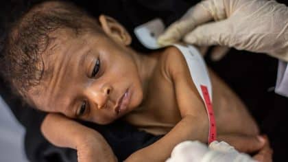 Yemen, fame e malnutrizione sono endemiche per i bambini del Paese, mentre la guerra si intensifica